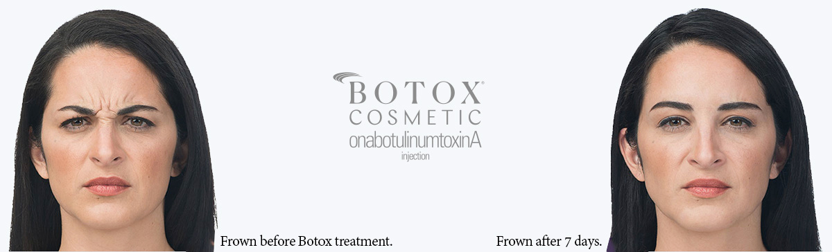 Botox Botox