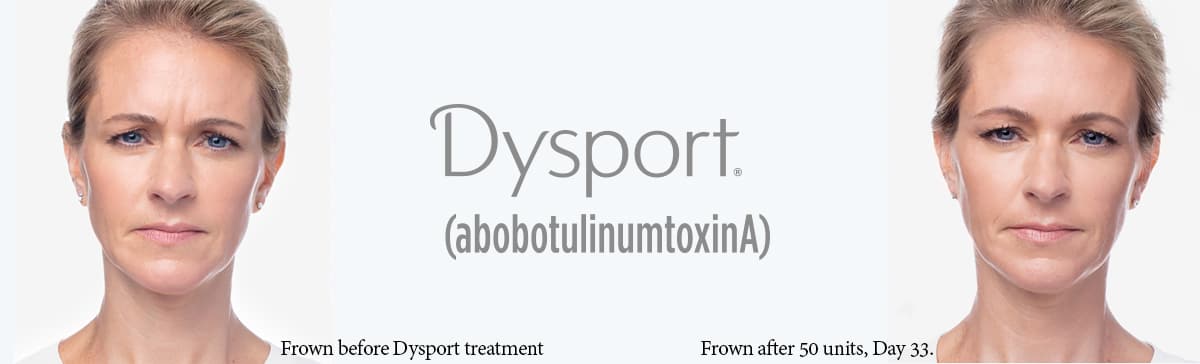 Dysport Dysport